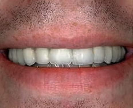 Dental implant patient after treatment at Nooga Dentistry