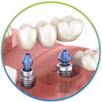 Dental Bridges in Chattanooga, TN